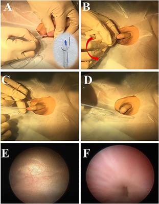 Feasibility and Safety of a Simple Non-cystoscopic Double-J Tube Removal Technique in Children
